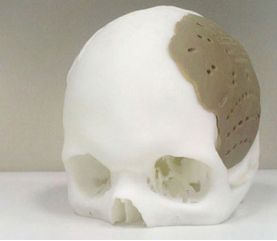 Часть черепа напечатанная на 3D принтере из ПЭК (Oxford Performance Materials)